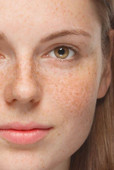 Clinical skin examination for pigmentation and melasma